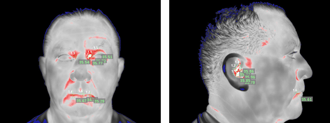 Infrared Fever Detection
